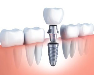 Dental Implant Service