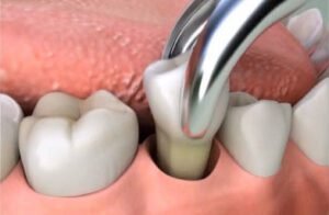 Tooth Extraction