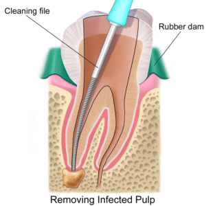 Root Canal Treatment