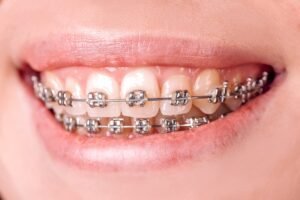 Traditional braces