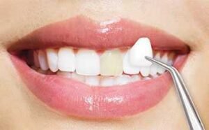 Veneers(1)