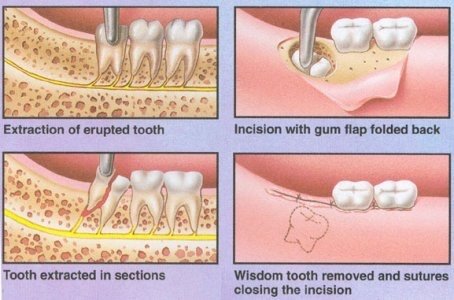 Wisdom tooth removal